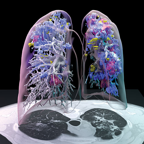 transparent lungs with visible bronchi and tuberculosis lesions inside.  Lungs are hovering over a stack of CT images