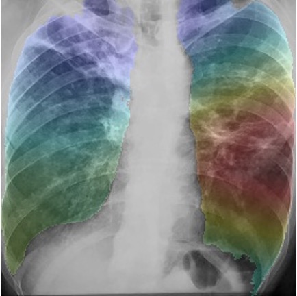 Image 2 lungs