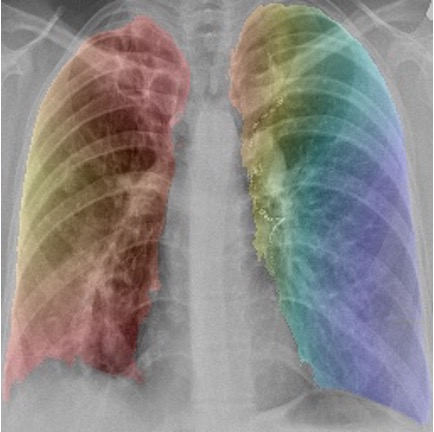Image 1 lungs